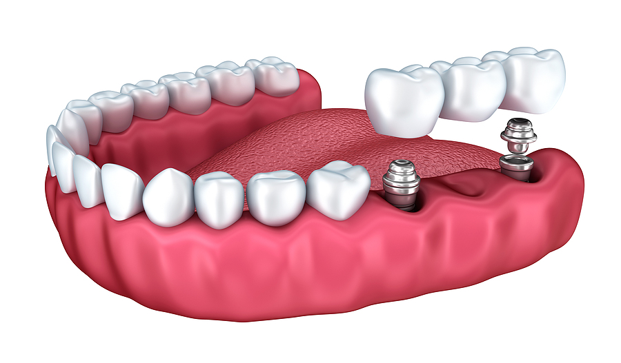 Restore Your Smile with Dental Implants in Queens, NY