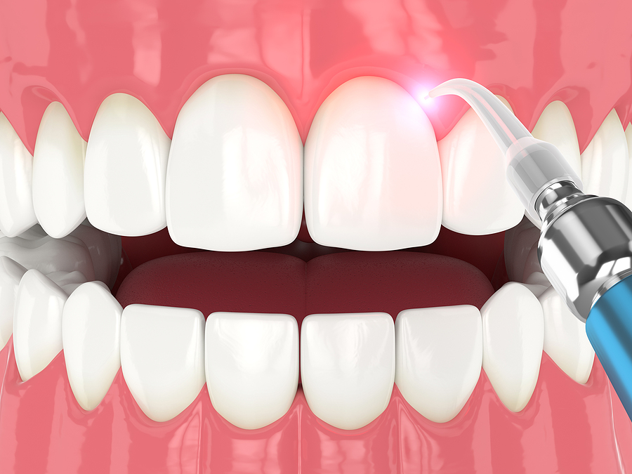Transforming Periodontal Care: Exploring Laser Gum Therapy in Queens, NY